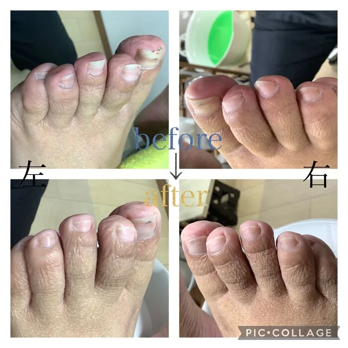 画像3933：30代女性/肥厚爪ケア