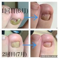 画像3939：30代女性/肥厚爪ケア