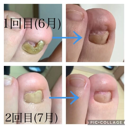 画像3939：20代女性/肥厚爪ケア(定期メンテナンス:2回目)