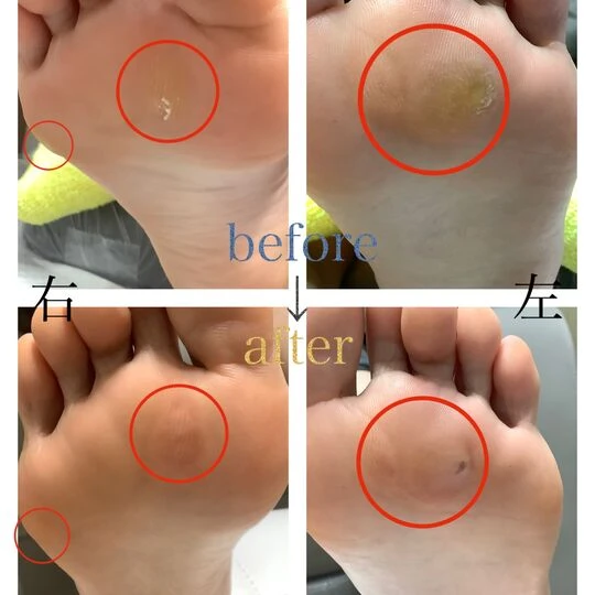 画像3941：30代女性/たこ・魚の目、角質ケア