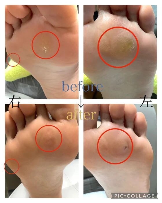 画像3941：30代女性/肥厚爪ケア