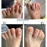 画像4544：30代女性/肥厚爪ケア