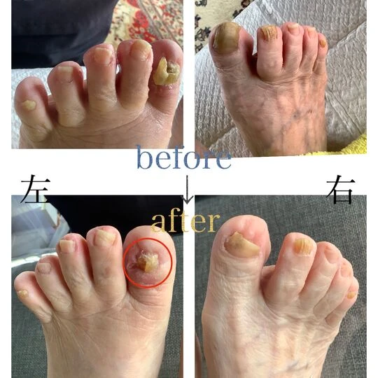 画像4544：90代女性/肥厚爪ケア(出張施術:1回目)