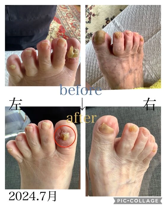 画像4544：30代女性/肥厚爪ケア