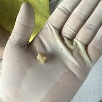 画像4545：30代女性/肥厚爪ケア