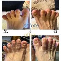 画像4547：30代女性/肥厚爪ケア