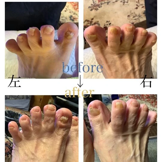 画像4547：90代女性/肥厚爪ケア(出張施術:2回目)