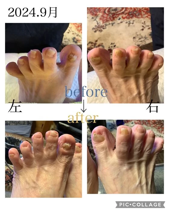 画像4547：30代女性/肥厚爪ケア