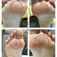 画像4549：30代女性/肥厚爪ケア