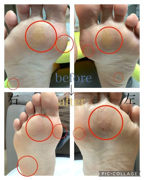 画像4549：30代女性/肥厚爪ケア