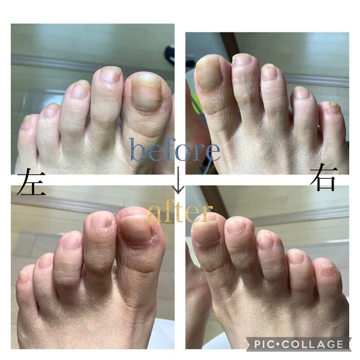 画像4550：30代女性/肥厚爪ケア