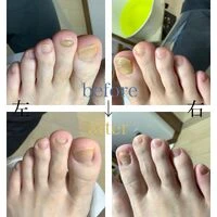画像4553：30代女性/肥厚爪ケア
