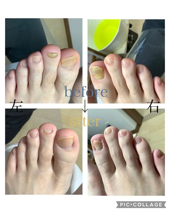 画像4553：30代女性/肥厚爪ケア