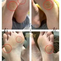 画像4556：30代女性/肥厚爪ケア