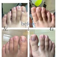 画像4557：30代女性/肥厚爪ケア
