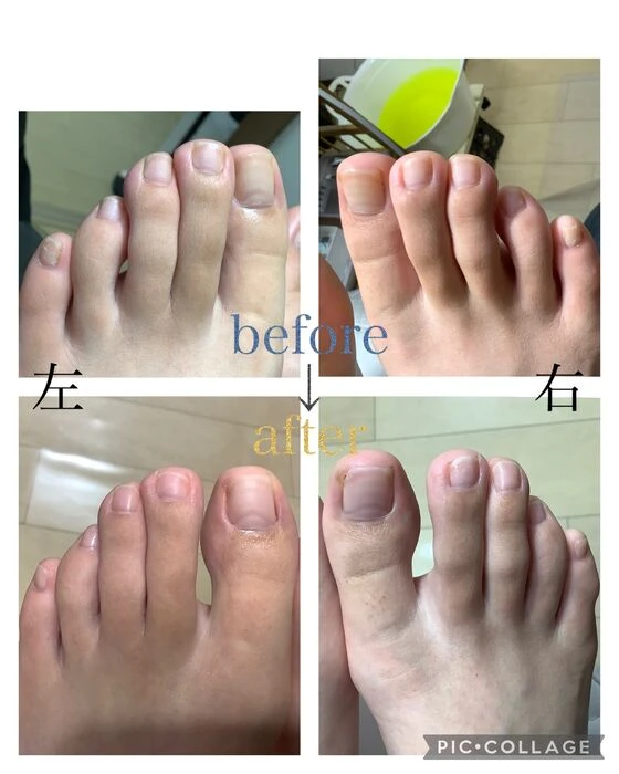 画像4557：30代女性/肥厚爪ケア