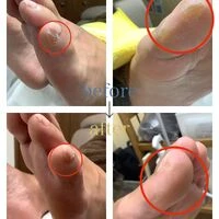 画像4560：30代女性/肥厚爪ケア