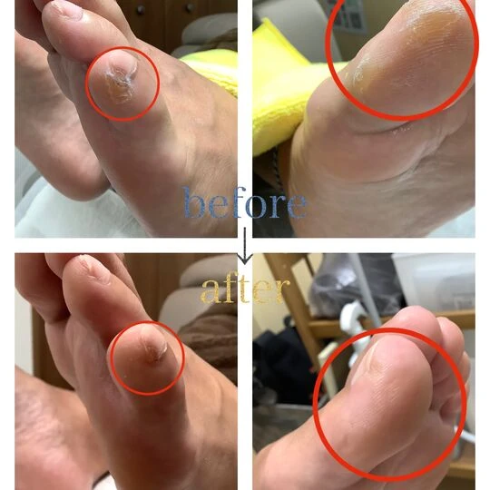 画像4560：50代男性/タコ・魚の目、角質ケア
