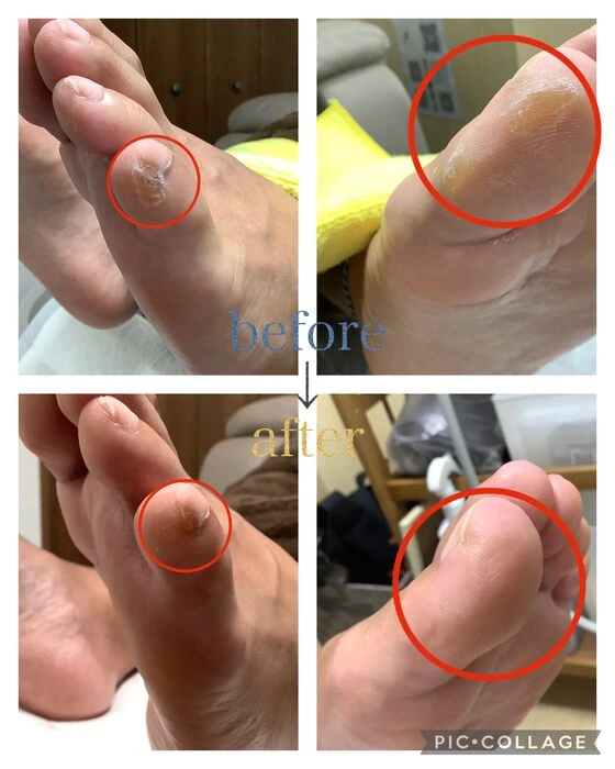 画像4560：30代女性/肥厚爪ケア