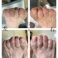 画像4566：30代女性/肥厚爪ケア