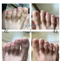 画像4569：30代女性/肥厚爪ケア