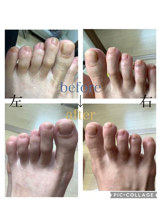 画像4569：30代女性/肥厚爪ケア